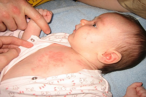Lá khế đun nước tắm cho bé khi bị rôm sảy có khả năng sát trùng, ức chế vi khuẩn