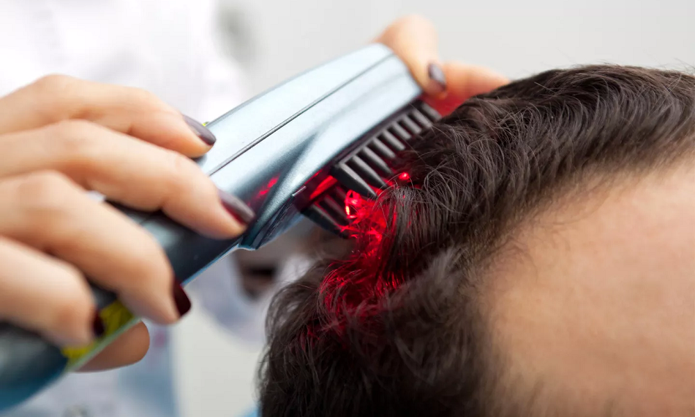 Phương pháp laser là biện pháp dùng ánh sáng thấp điều trị bệnh hói đầu 